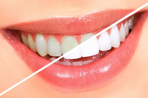 Clareamento Dental