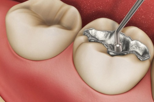 Restauração Odontológica